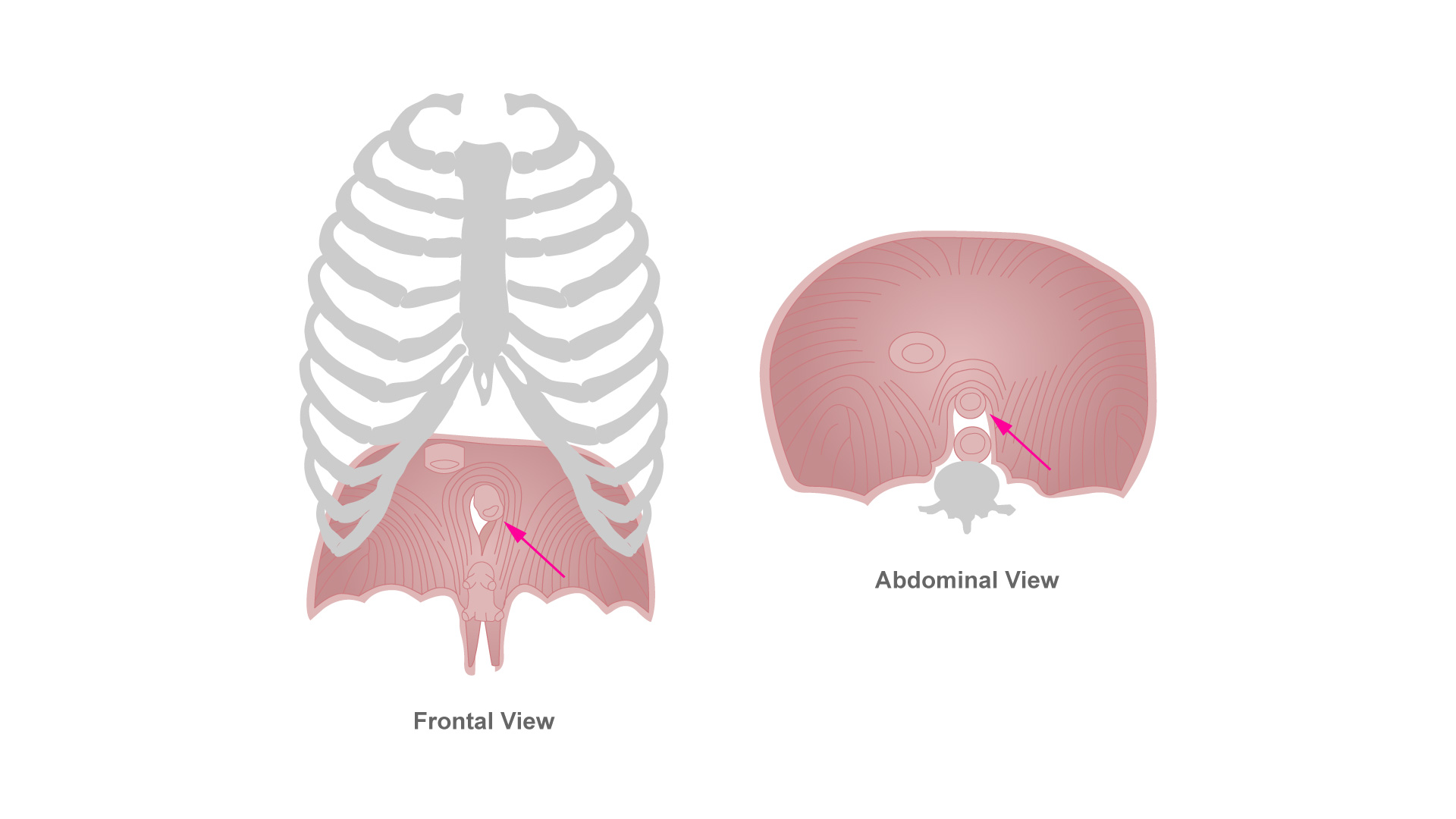 Figure shows esophagus passage through crural diaphragm. (Courtesy Conan Romanyk)